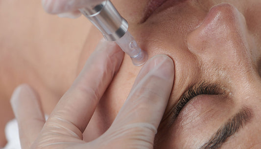 micro needling treatment on client's face