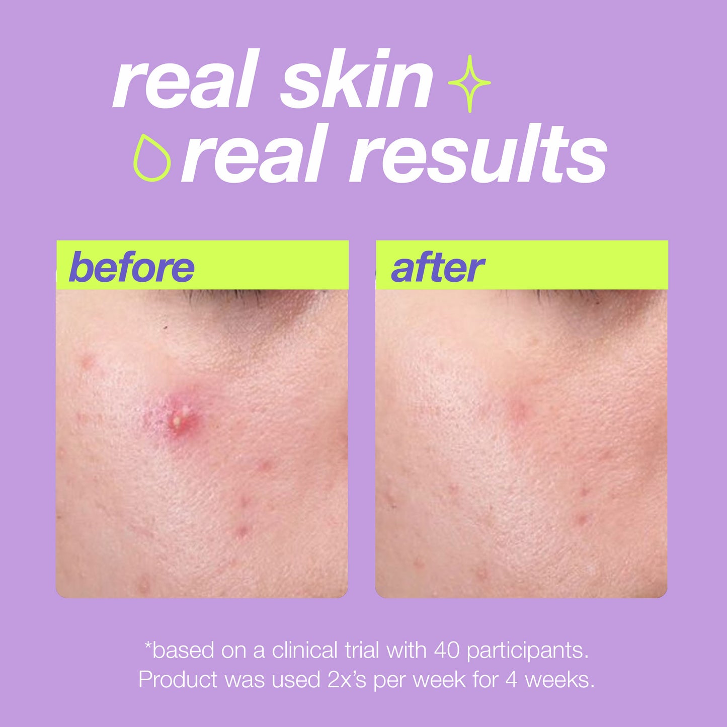 Breakout Clearing Liquid Peel