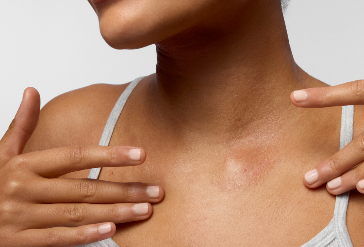 Understanding Sensitive, Reactive & Sensitised Skin