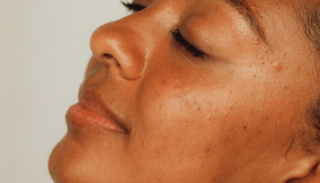 There’s A Difference Between Spots And Acne?
